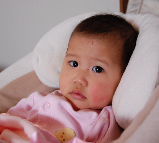 toddler cheek rash